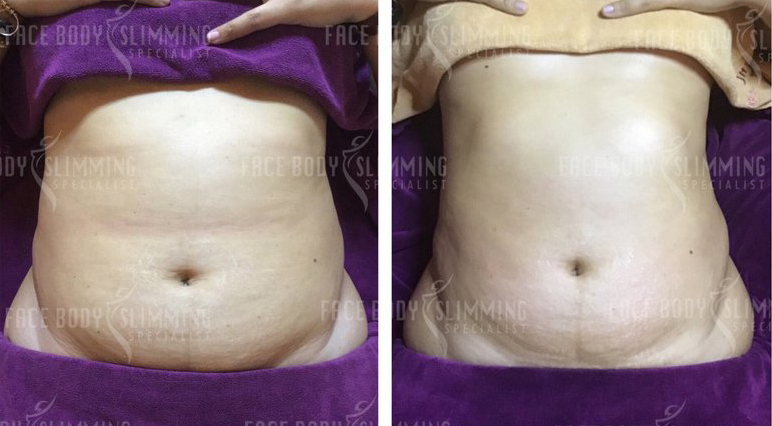 Body slimming treatment result example 1
