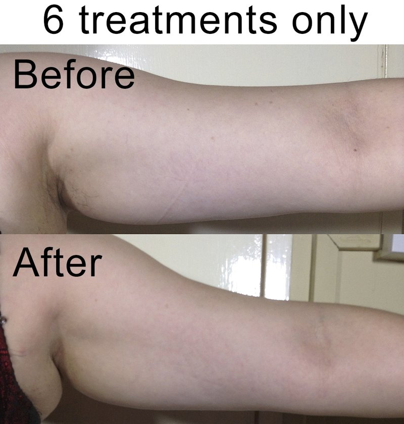 Body slimming example for targeted area support