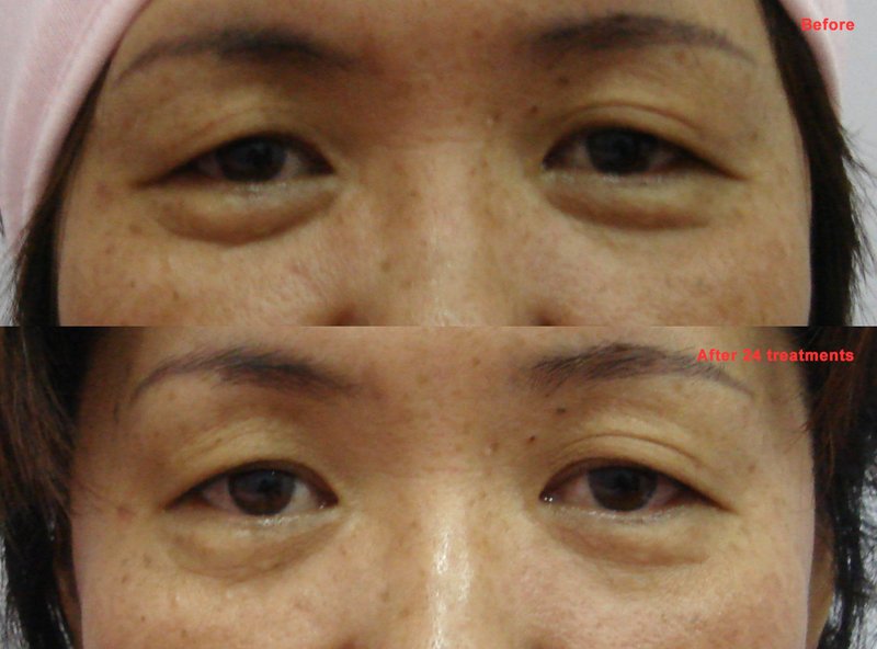 Eye treatment result example 1