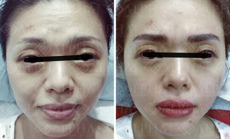 Face slimming treatment result example 1