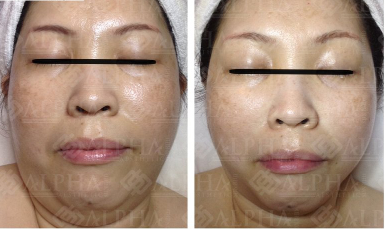 Face slimming treatment result example 2