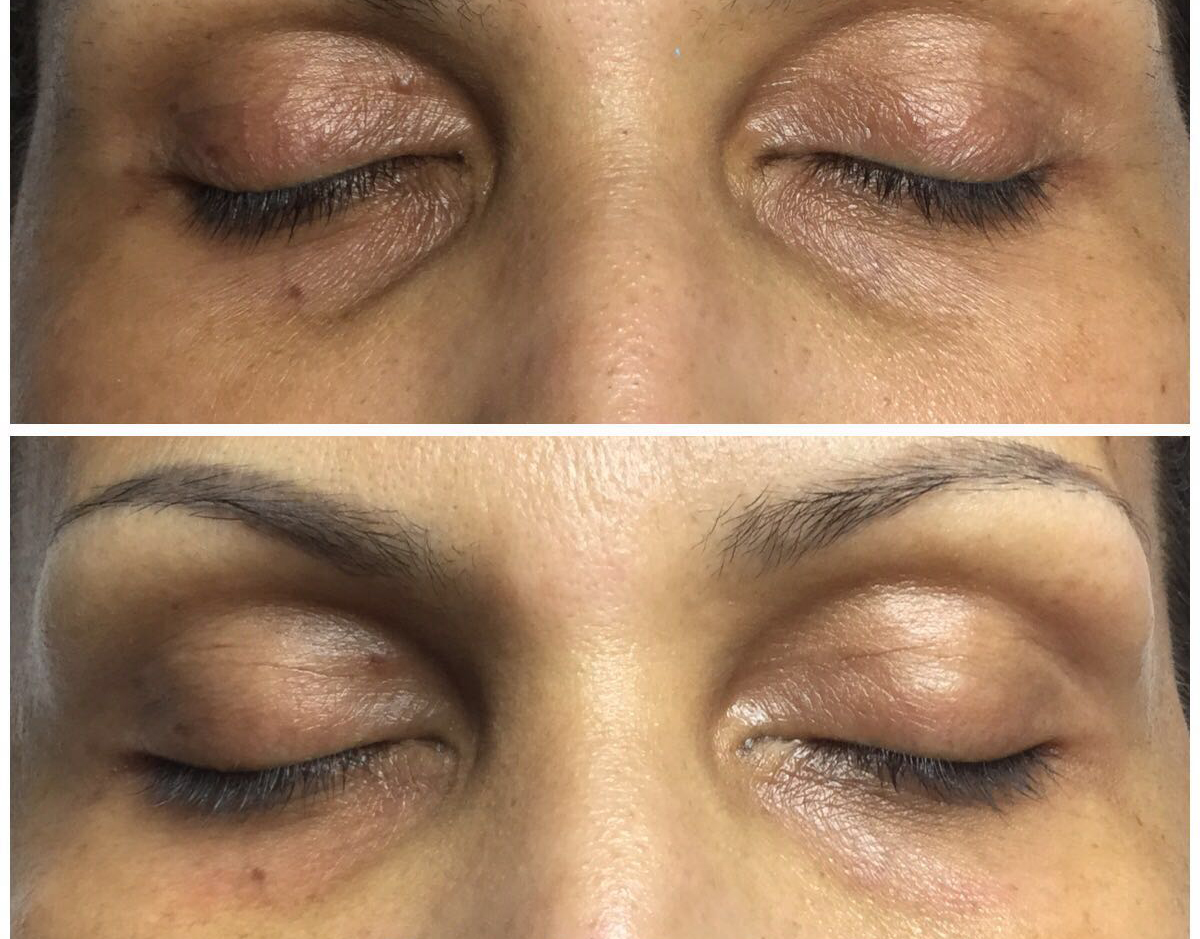 Eye treatment result example 2
