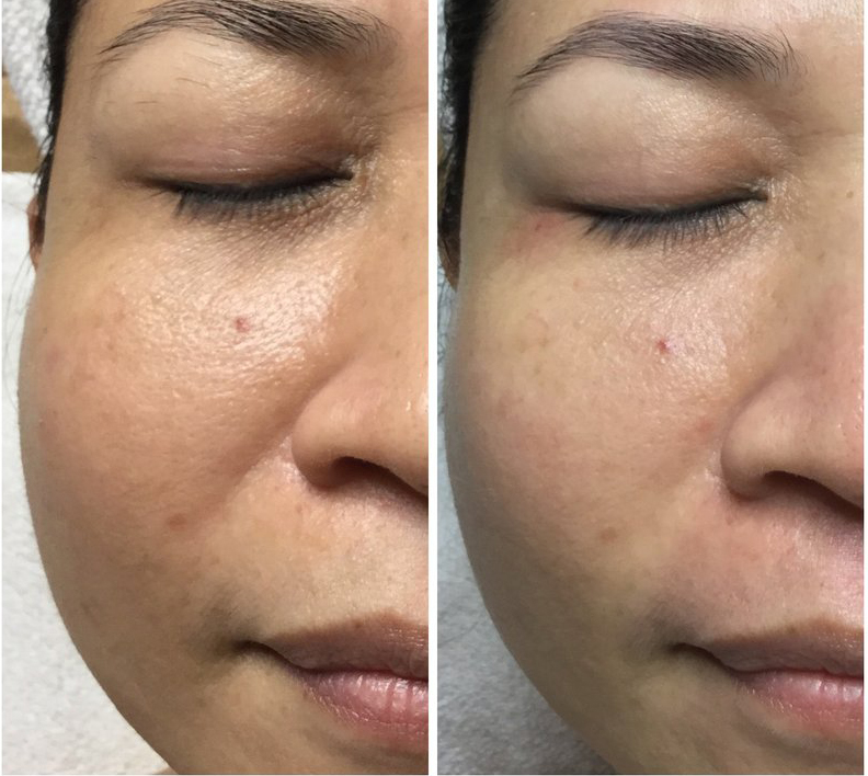 Face rejuvenation treatment result example 1