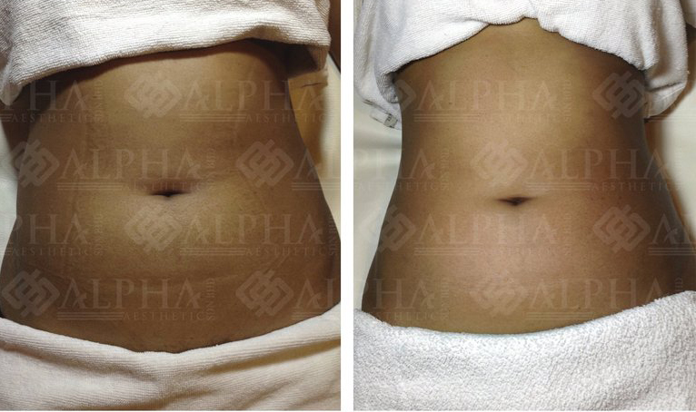 Targeted area slimming result example 3