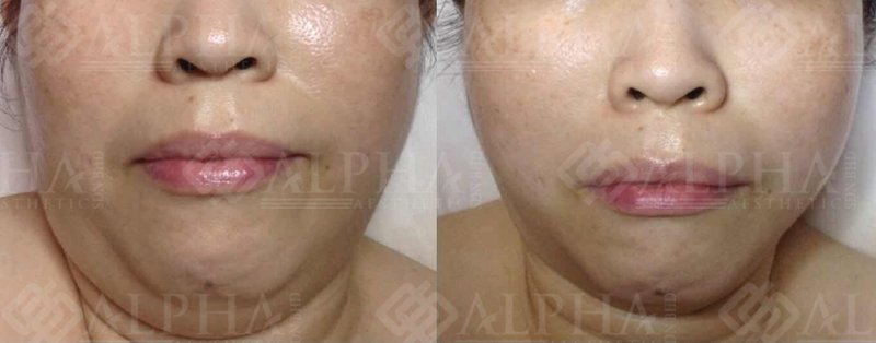 Face slimming treatment result example 3